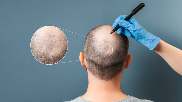 Hair Loss Treatment