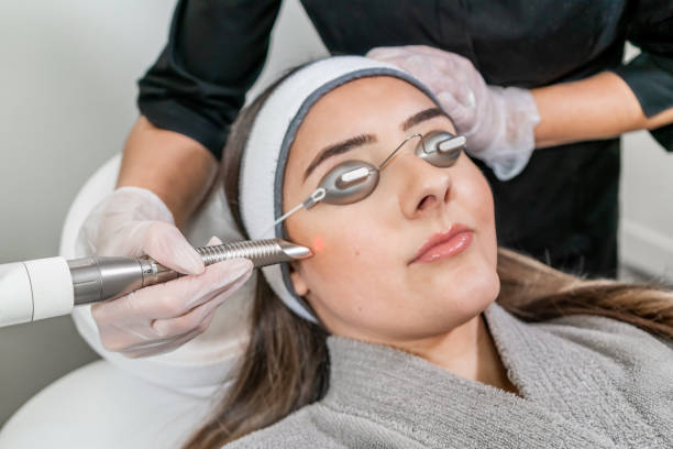Laser Skin Resurfacing