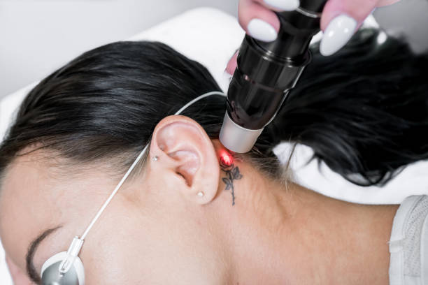 Tattoo Removal