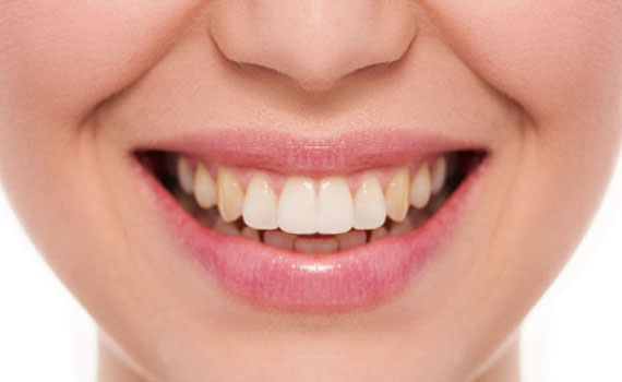 smile-2-1