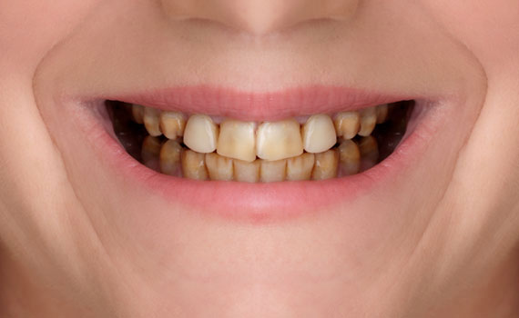 smile-4-1