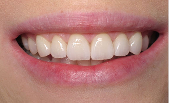 smile-6-2
