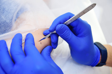Mole Treatment